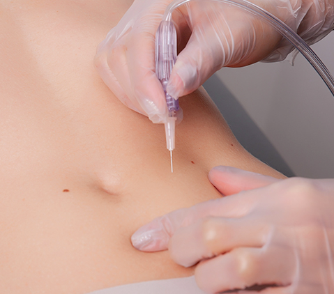TRATAMIENTO REDUCTIVO CON CARBOXITERAPIA + L-CARNITINA Clnica Globalmedic TRATAMIENTO REDUCTIVO CON CARBOXITERAPIA + L-CARNITINA Clnica Globalmedic
