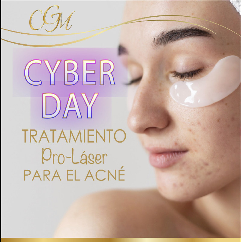TRATAMIENTO MULTI-LÁSER PARA EL ACNÉ