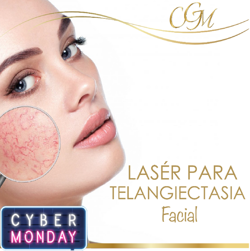 TRATAMIENTO MULTI-LÁSER PARA TELANGIECTASIA (Arañitas Vasculares)
