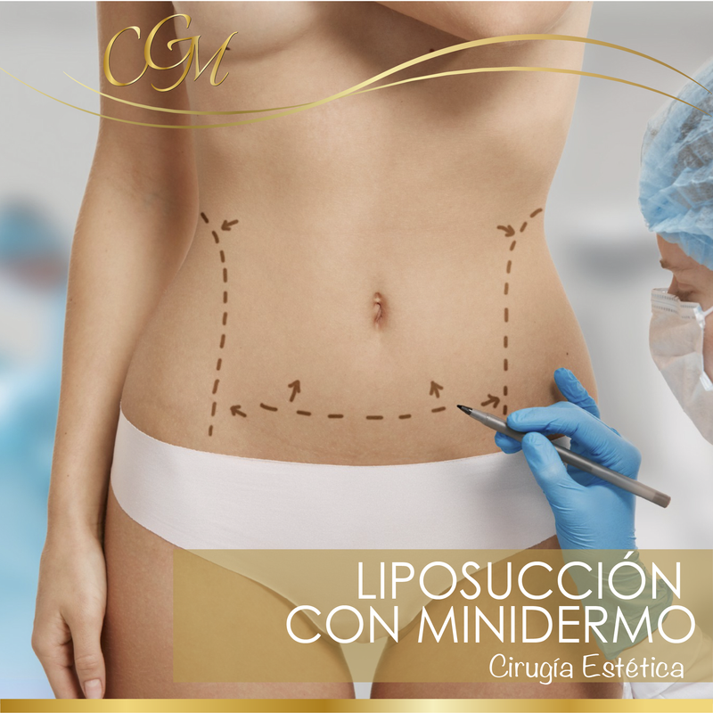 LIPOSUCCIÓN CON MINI DERMOLIPECTOMIA