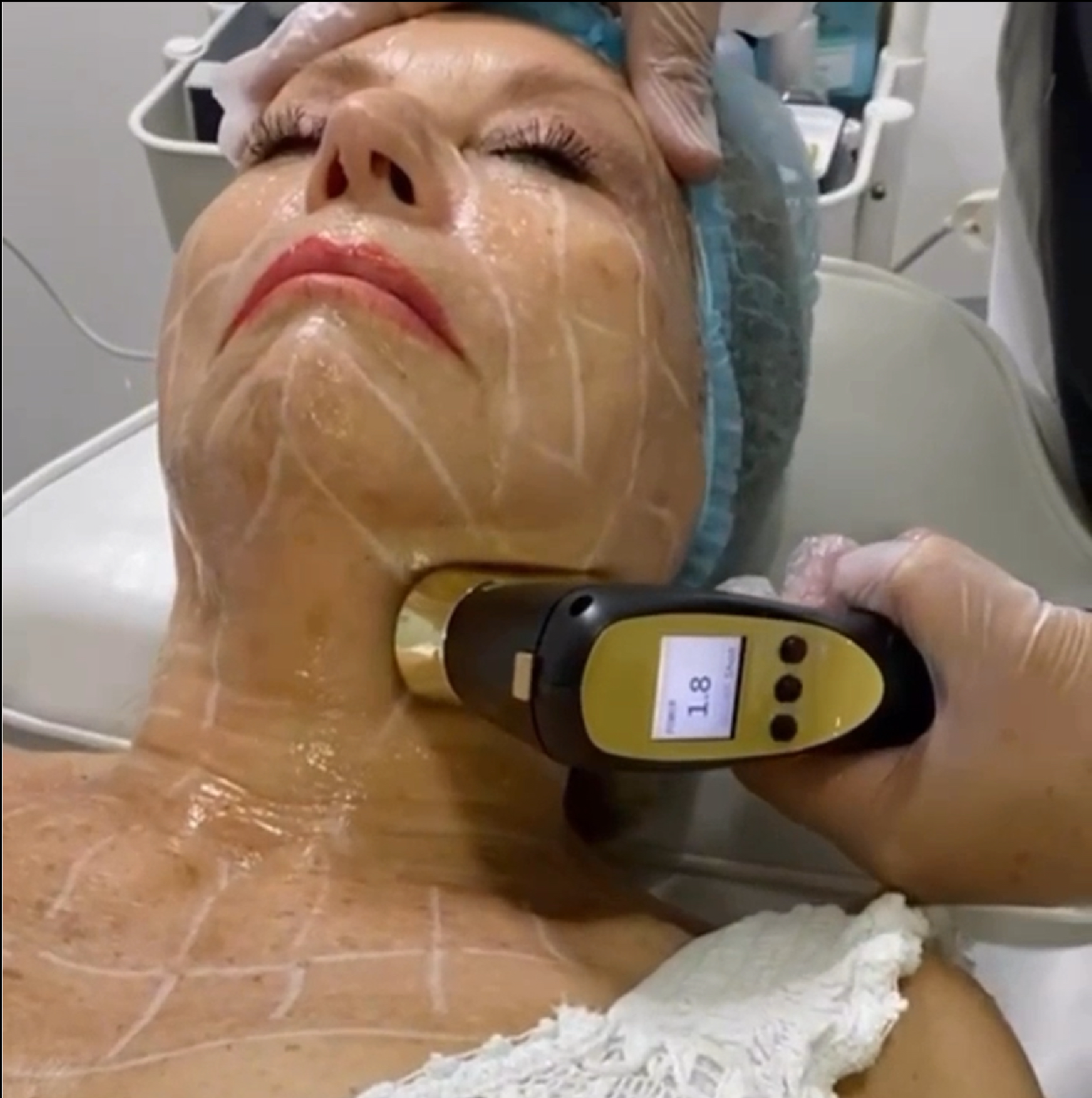 Qué es el HIFU 22d y cómo funciona Rejuvenecimiento sin cirugía