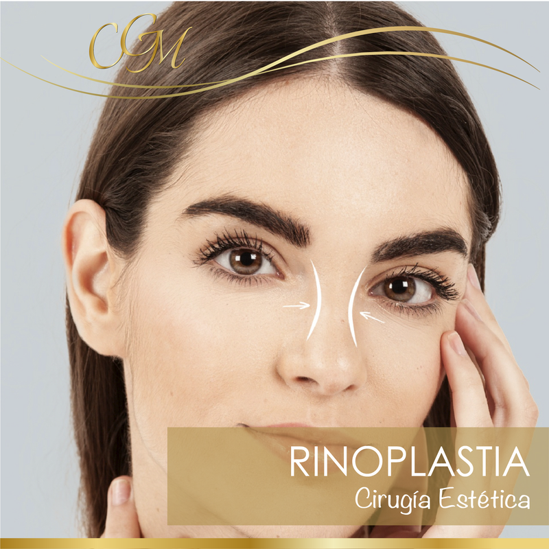 RINOPLASTIA