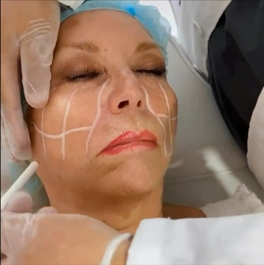 BLANQUEAMIENTO CON LÁSER – Clínica Globalmedic - Main Image