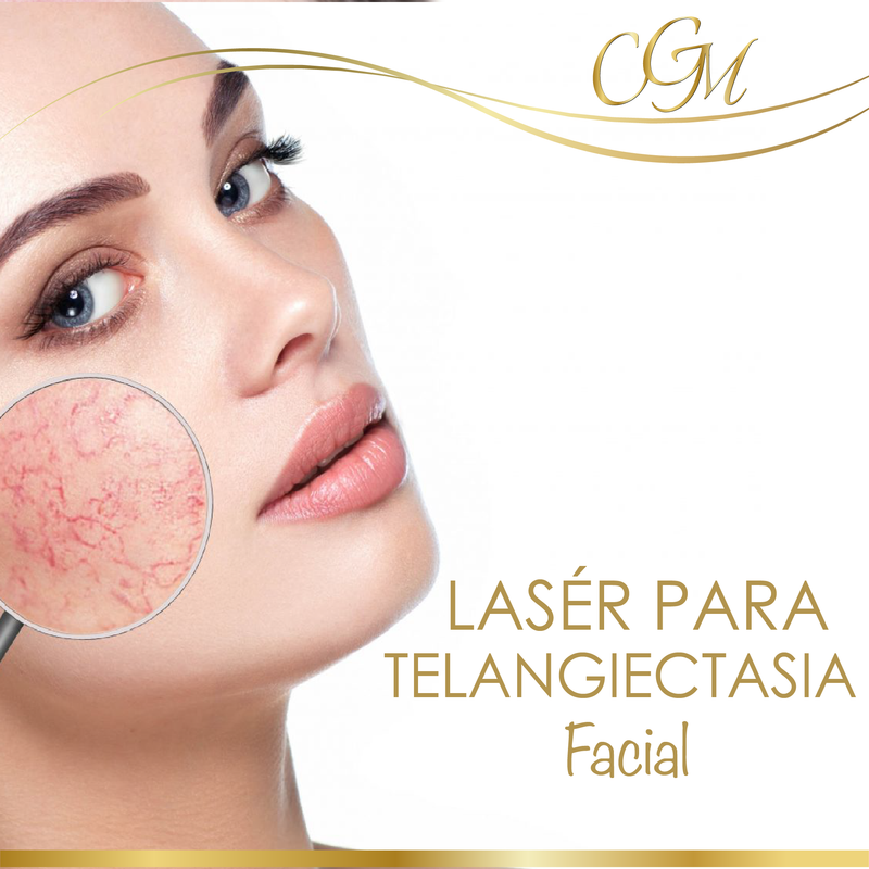 TRATAMIENTO MULTI-LÁSER PARA TELANGIECTASIA (Arañitas Vasculares)